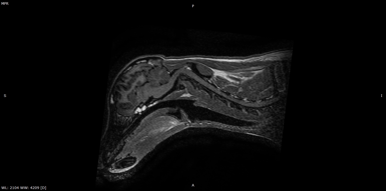 usp_post_image_3D_MPR_-_DOGI_MOLI_-_3_6_2019_5_49_56_PM_-_AX_T1_3D_FSPGR_IR-PR_0000-1.jpg